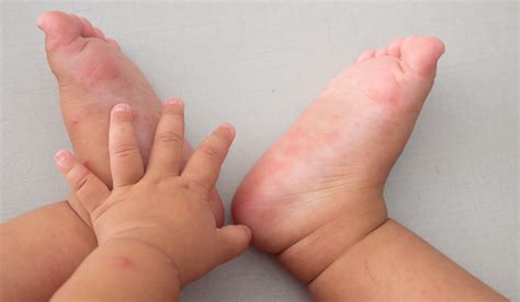 Understanding Hand Foot And Mouth Disease Dr Andrea D Burns Md