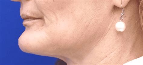 10 Different Types And Shapes Of Chin A Comprehensive List Ach