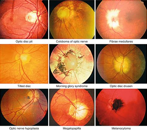 Congenital Diseases Of The Optic Nerve Springerlink