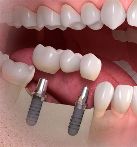 Multiple Dental Implants Mandurah Peel Dental Studio