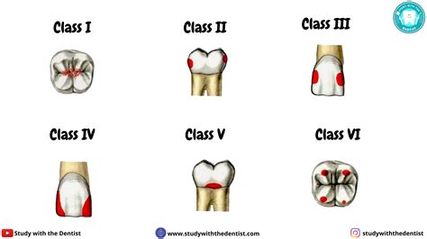 G V Blacks Classification Of Dental Caries Study With The Dentist