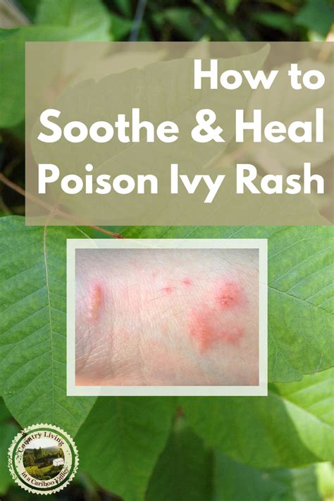 How To Get Rid Of Poison Ivy On Skin Home Remedies
