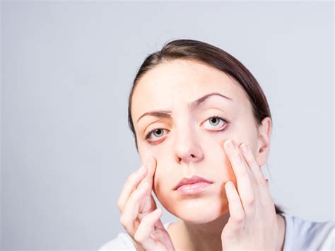 Worried Of Eyelid Pimples Treat Them Effectively With These Home