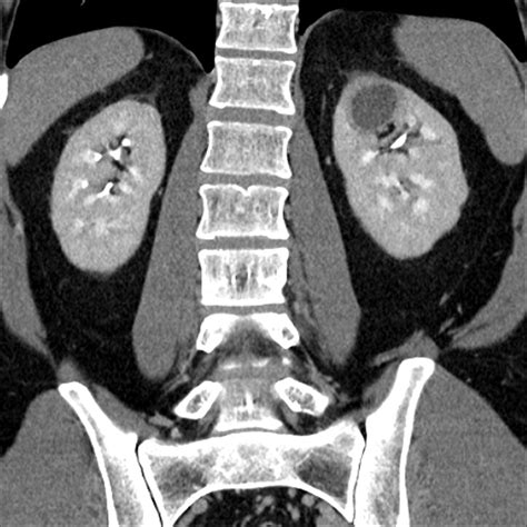 CT And MR Imaging For Evaluation Of Cystic Renal Lesions And Diseases