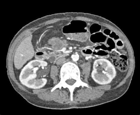 Lymphoma Involves The Terminal Ileum Small Bowel Case Studies