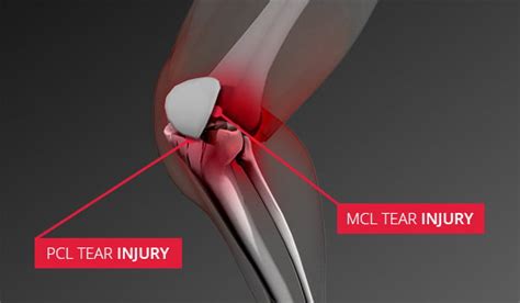 Mcl And Pcl Knee Injuries Sterling Medical Group