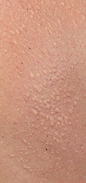 Best Hives Skin Condition Stock Photos Pictures And Royalty Free Images