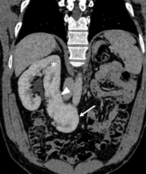 Congenital Anomalies Of The Upper Urinary Tract A Comprehensive Review
