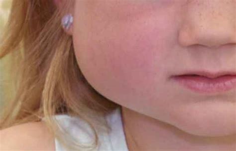 Swollen Cheek Symptoms Causes Treatment Pictures
