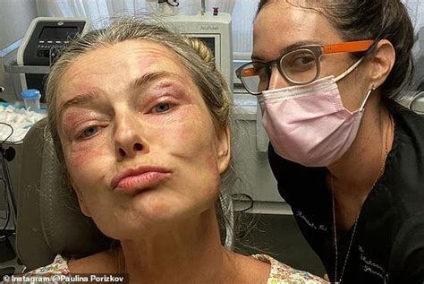 paulina porizkova reveals sores around her eyes after undergoing skin tightening treatment