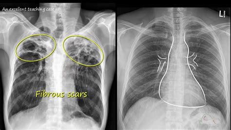 Chest X Ray Tuberculosis Healed Tb Inactive Tb Youtube