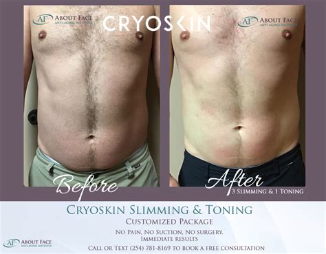 Cryoskin Toning And Body Shaping Central Tx About Face Anti Aging