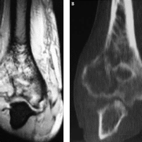 Medial Signs Of Primary Lymphoma Of The Bone Between Men And Women A