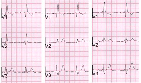 Dr Smiths Ecg Blog Rbbb With Dynamic T Waves