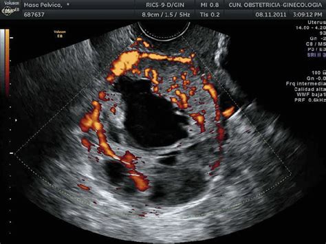 Ovarian Cancer Ultrasound Ovarian Cyst Transvaginal Ultrasonography