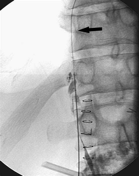 Nonoperative Thoracic Duct Embolization For Traumatic Thoracic Duct