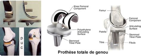 • l'extrémité inférieure du fémur qui a la forme de deux roues accolées : Prothèse de genou
