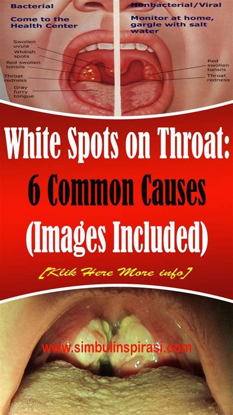 White Spots On Throat 6 Common Causes Images Included
