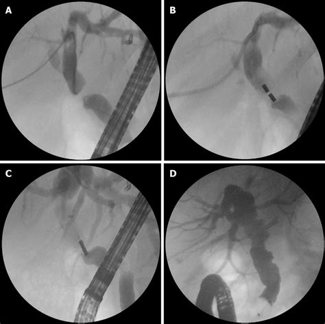 Magnetic Compression Anastomosis For Biliary Obstruction 34 A