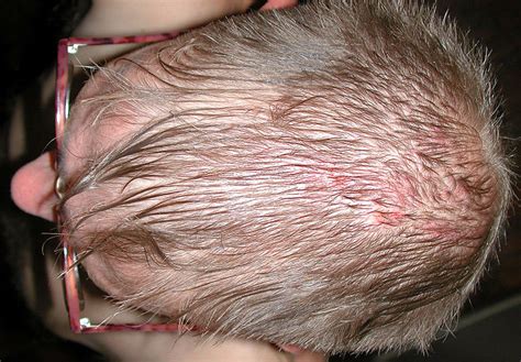 Itchy Scalp Symptoms Pictures Causes Treatment Remedies Dry