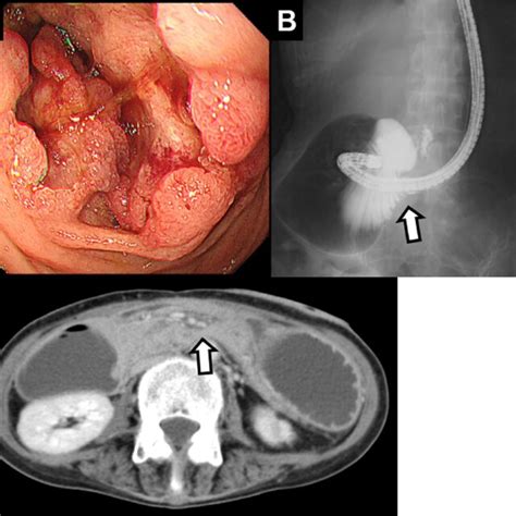 A Upper Gastrointestinal Endoscopy Revealing A Type Tumor In The Download Scientific Diagram