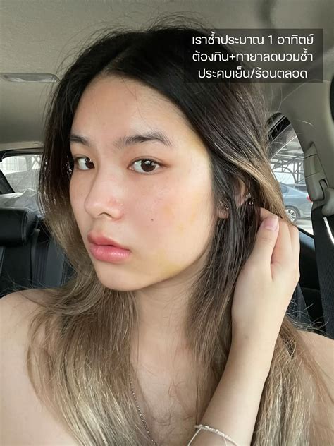 ฉีดหน้าแบบใดห์🥺ถึง'ช้ำ'แบบนี้? | แชร์ปสกหลังโดนเข็มจิ้มหน้า💉🩸 | แกลเลอ