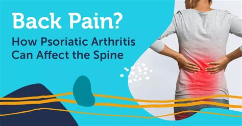 Back Pain How Psoriatic Arthritis Can Affect The Spine Mypsoriasisteam