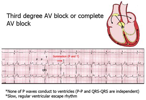 This is the only degree of sa block that can be recognized on the surface ecg (i.e., intermittent conduction failure between the. 3rd Degree AV Block | Login | P wave, Ekg, Abnormal
