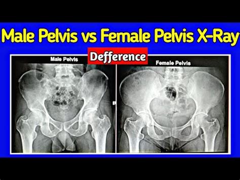 Male Pelvis Vs Female Pelvis Difference Pelvis X Ray UdayXray YouTube