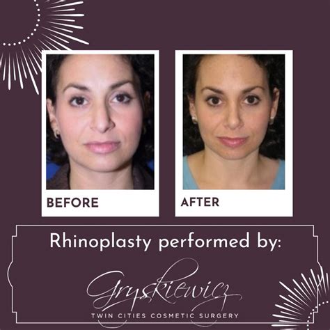 Before And Gryskiewicz Twin Cities Cosmetic Surgery