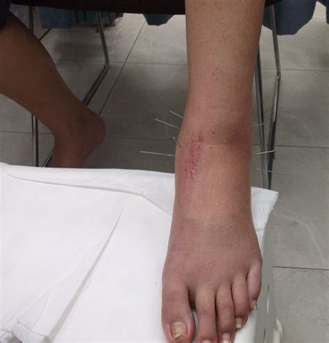 Tcm News Tcm Clinic In Singapore Treat Leg Injury Ankle Sprain