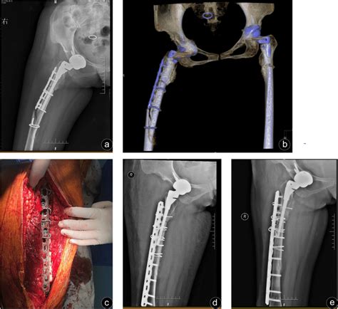 A 41 Year Old Female Who Sustained A Vancouver Type B1 Fracture