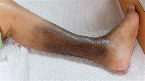 Leg Discoloration El Paso Tx Imaging And Interventional Specialists