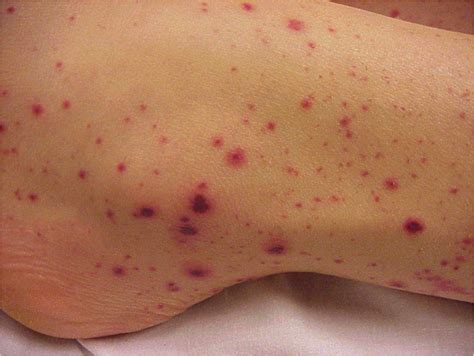 Medicine 12345 None Flashcards Describing Skin Lesions Studyblue