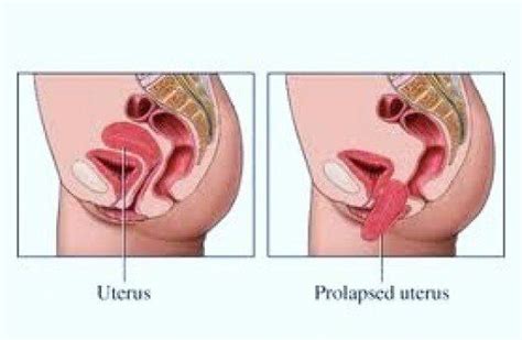 Pelvic Organ Prolapse What is it Prolapso uterino Vejiga caida Pélvico