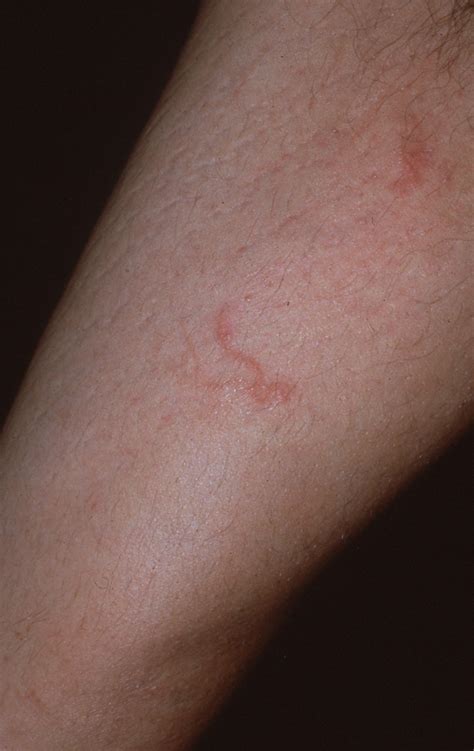 Not All Round Rashes Are Ringworm A Differential Diagnosis Of 2022