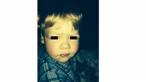 Нефротический синдром диета 02-23. Первичный нефротический синдром - YouTube 02-23. Первичный нефротический синдром - YouTube Нефротический синдром диета