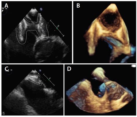 Cardiac Interventions Today Prominent Eustachian Valve And Unusual