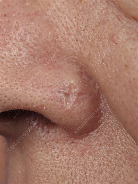 Basal Cell Carcinoma Of The Nasal Wing Stock Image C0507420
