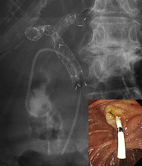 Endoscopic Transpapillary Gallbladder Stent Placement In The Presence