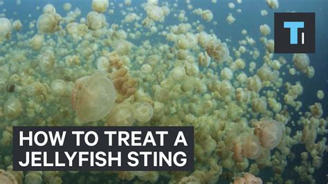 How To Treat A Jellyfish Sting Youtube