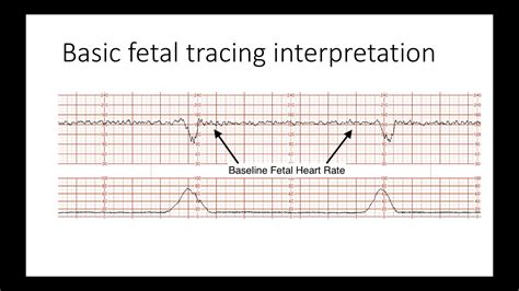 Interpreting Intrapartal Fetal Heart Rate Tracings Youtube