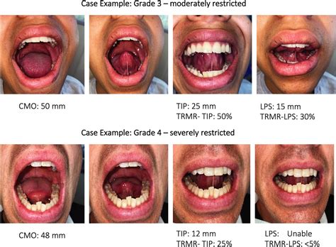 assessment of posterior tongue mobility using lingual‐palatal suction progress towards a