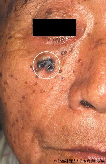 メラノーマ以外の皮膚悪性腫瘍 Q2 皮膚科q＆a（公益社団法人日本皮膚科学会）