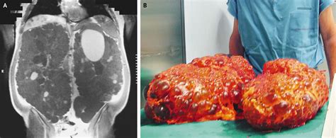 If you're on the lookout for foods that can help lower your risk. Autosomal Dominant Polycystic Kidney Disease â NEJM