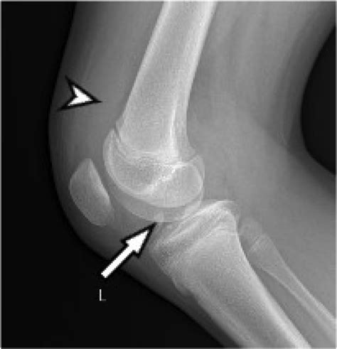 Preoperative Lateral Radiography Of The Left Knee Shows Joint Effusion