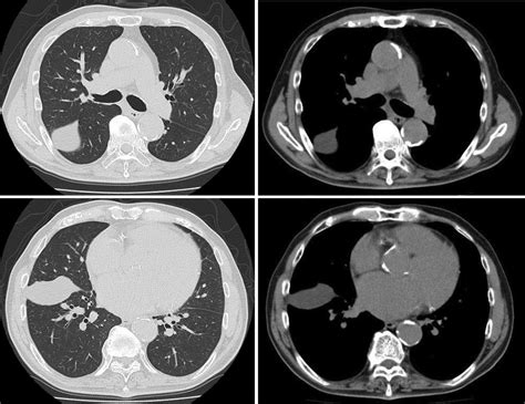 Loculated Pleural Effusion Ct Image Guided Drainage Of Intrathoracic