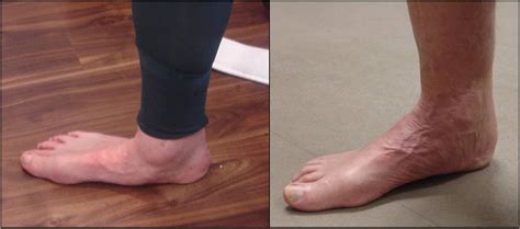 Flat Foot Surgery