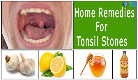 6 Simple And Effective Home Remedies For Tonsil Stones Thelifesquare