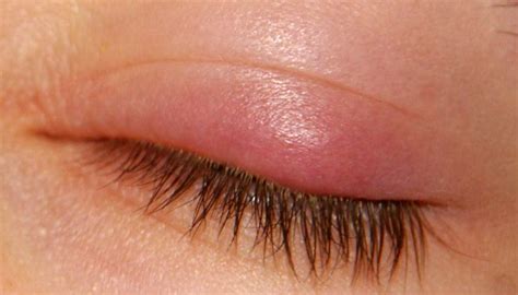 Chalazion Pictures Causes And Treatment